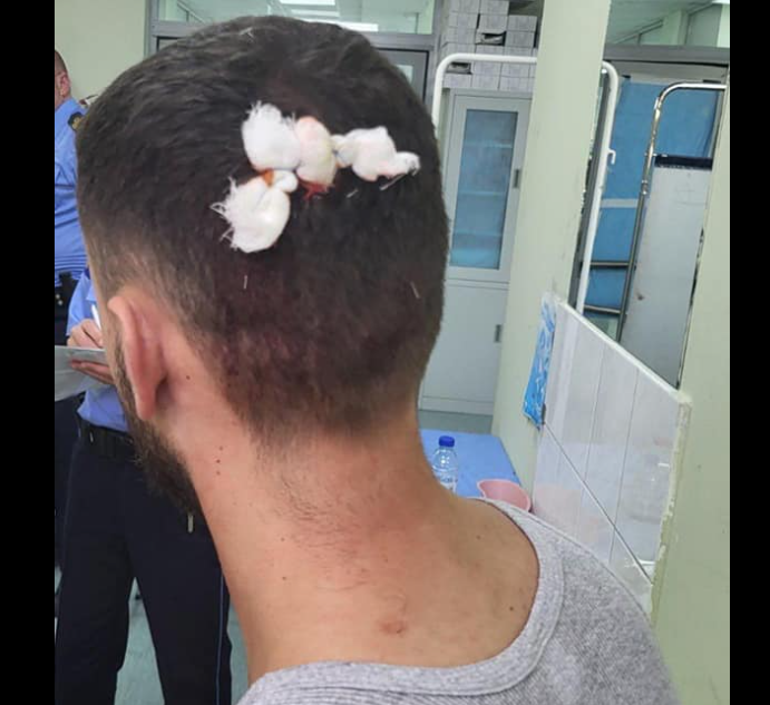Policia-Grupet kriminale në veri sulmojnë dy persona meshkuj kosovarë